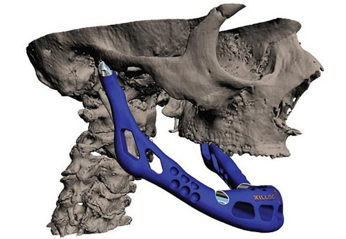 3D printed lower jaw bone