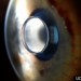implantable telescope, telescopic implant, FDA, VisionCare, California, Medicare, futuristic technology