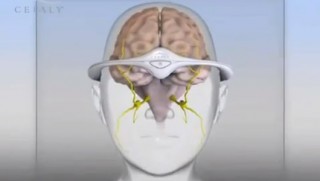 future, future technology, Headache Research Unit, University of Liège, Belgium, FDA, future device, Cefaly, Canada, electrical stimulation, futuristic