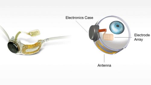 Futuristic Technology, Argus II Retinal Prosthesis System, Augmentation, Cyborg, Future Medicine, Implant, Eyes, Blindness, Ophthalmology