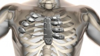 Cyborg Medicine: Patient receives first 3D-printed titanium sternum and rib cage. Cyborgization, Implant, Prosthetic, Future Medicine, Augmentation, Surgery