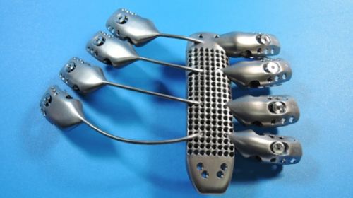 Cyborg Medicine, Patient, 3D Printeing, Titanium Sternum, Titanium Rib Cage,  Future Medicine, Cyborgization, Augmentation